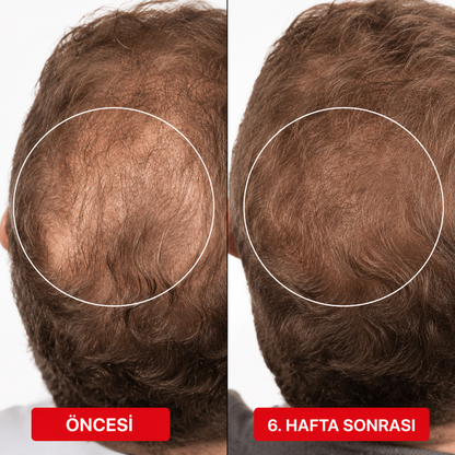 Kırmızı Işık Terapi Şapkası